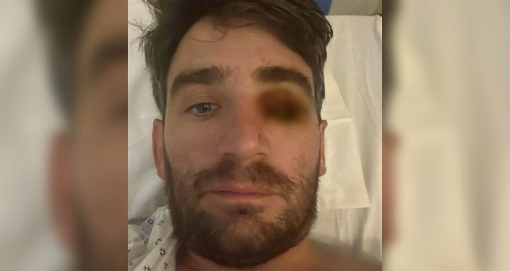 Explosión Pirotécnica en Fiesta de Año Nuevo en San Diego: Hombre Pierde el Ojo