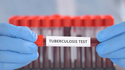 San Diego registra altas tasas de tuberculosis y autoridades llaman a la prevención